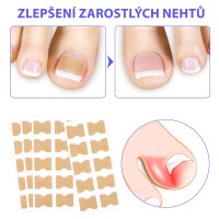 Wellife Náplasti proti zarůstání nehtů 100 ks